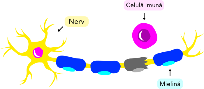 An immune cell damaging myelin on a nerve cell.